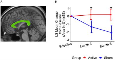 Spectris™ treatment preserves corpus callosum structure in Alzheimer's disease